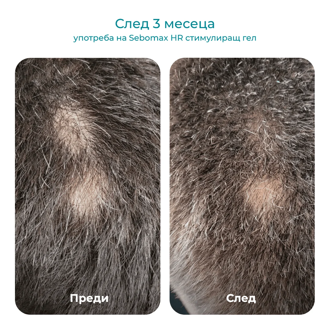 Sebomax Hair Regrowth стимулиращ гел против косопад и алопеция ареата при жени и мъже, 26 мл - Image 3
